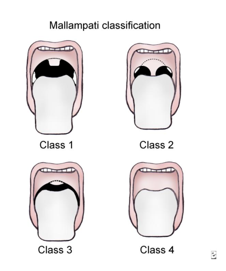 Mallampati Classification